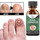 Fast Nail Fungal Treatments Nail Repair